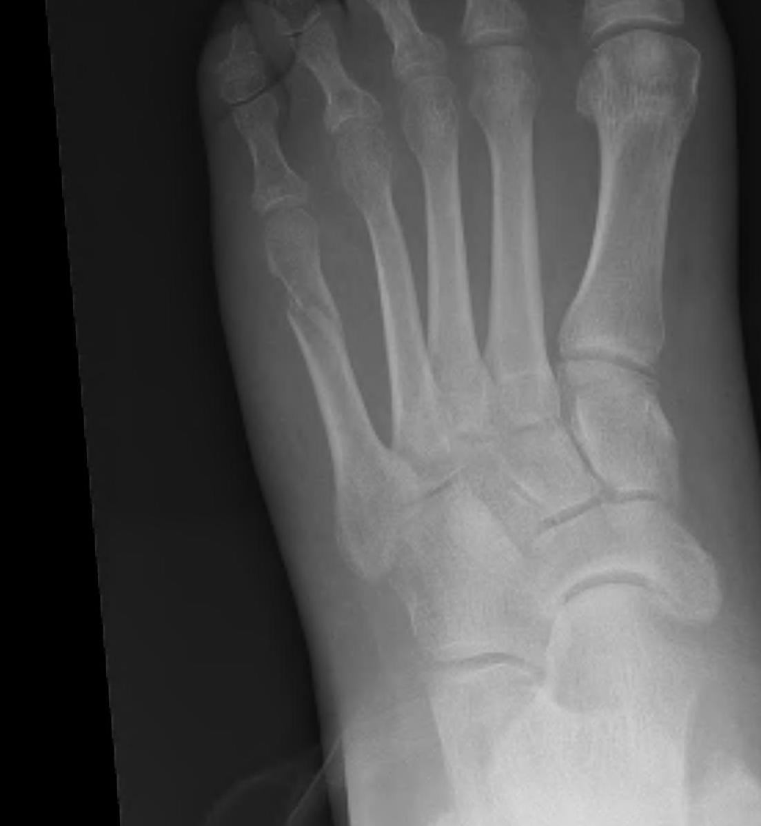 Fifth Metatarsal Neck Fracture